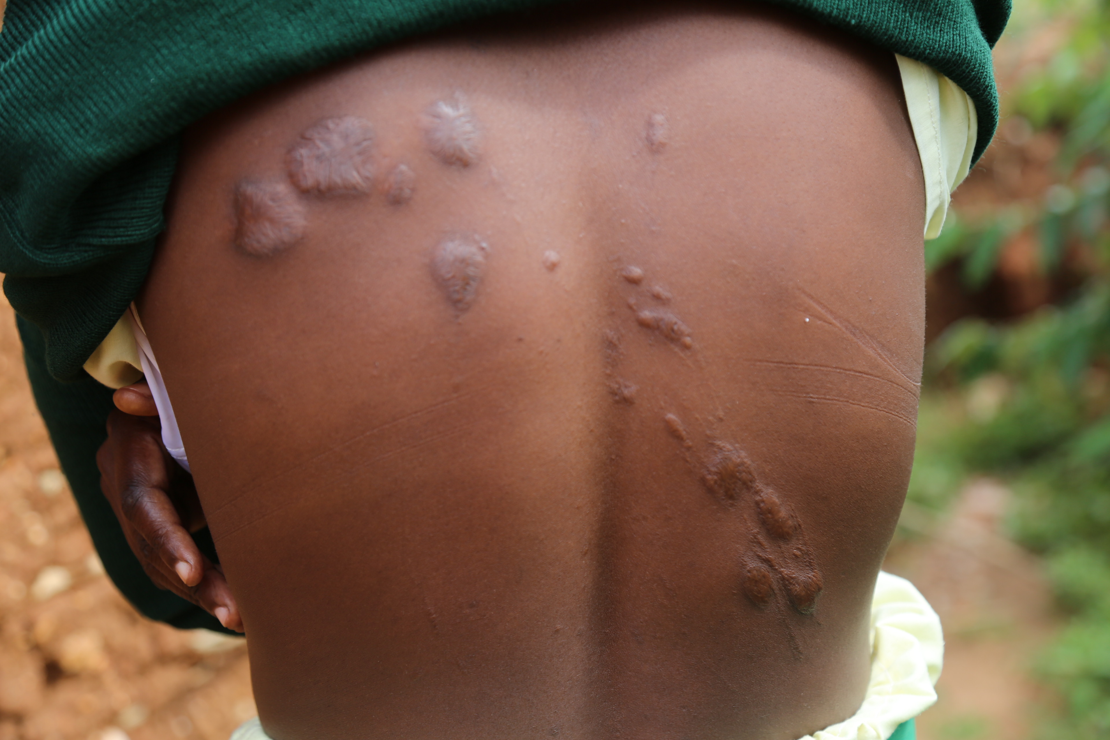 Chebet’s back was scarred by the severe beating she received.