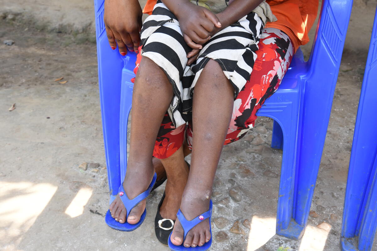 Healthy feet, and healing legs. Jusline can now play with the other children and is looking forward to finally starting school, where she will walk, just like the other big girls to school.
