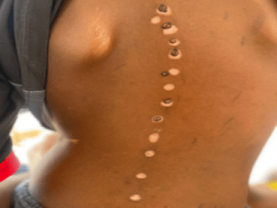 Boy with TB 