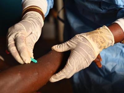 Hands of Choisie treating 2 patients affected by the Mpox