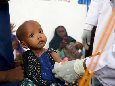 Hanan is severely malnourished and receiving support at a World Vision supported health facility