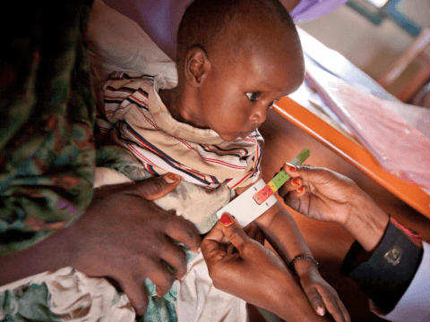 Treated malnourished child